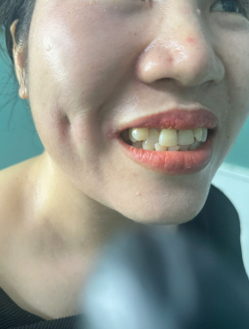 Nhấn đồng tiền